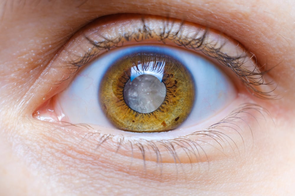 What Are Cataracts? Causes, Symptoms, and Early Warning Signs